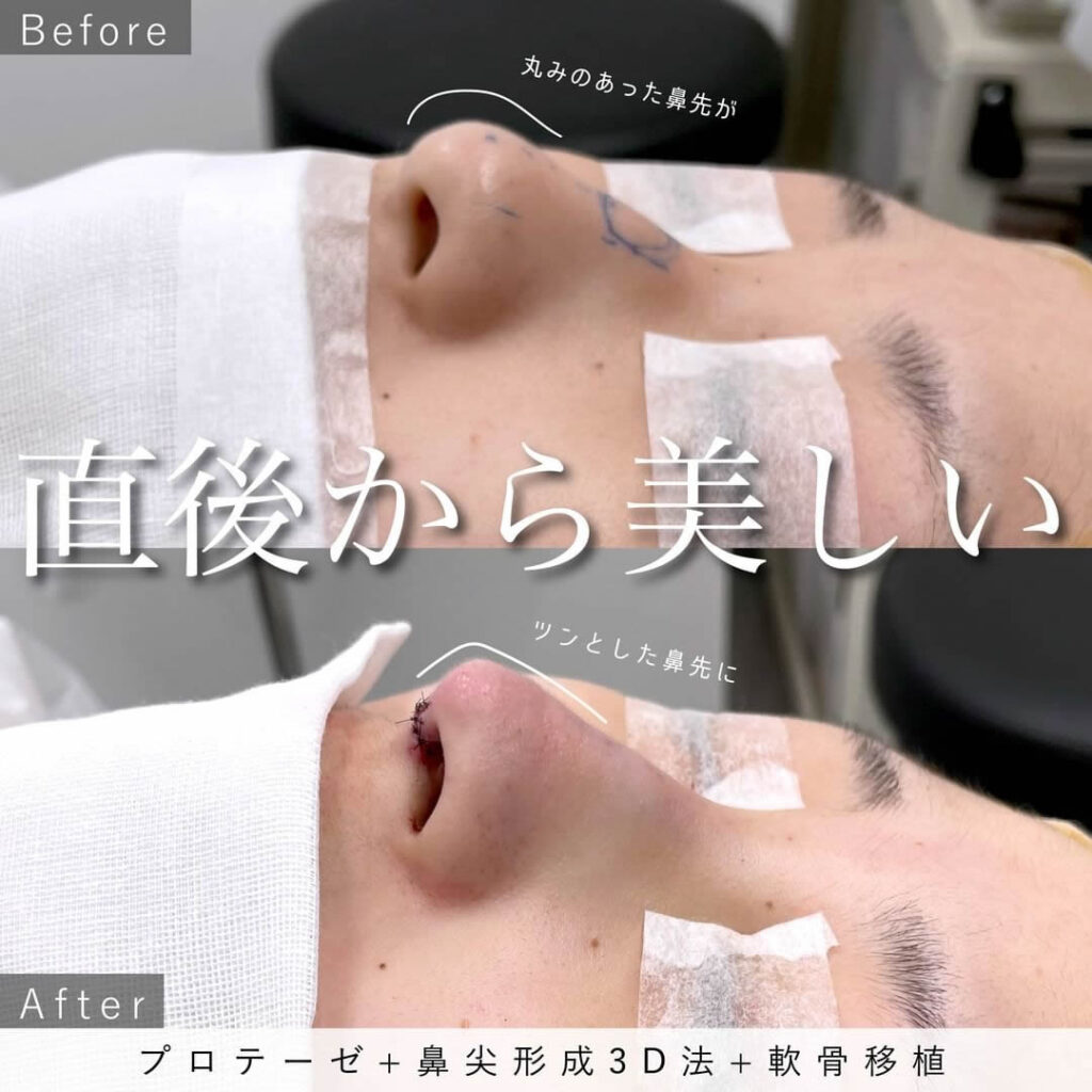 シリコンプロテーゼと鼻尖形成3D法と軟骨移植の症例写真