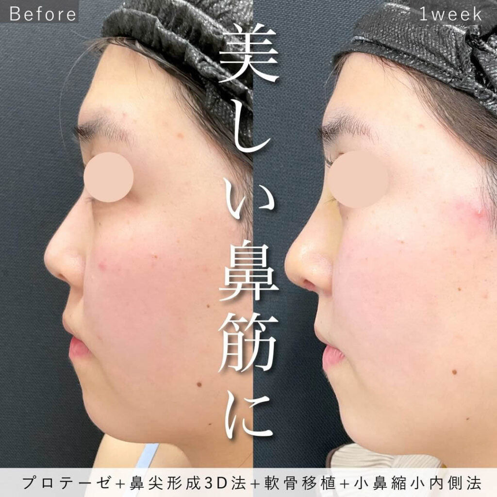 シリコンプロテーゼと鼻尖形成3D法と軟骨移植と小鼻縮小内側法の症例写真