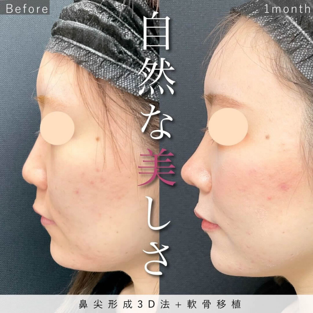 鼻尖形成3D法と軟骨移植の症例写真