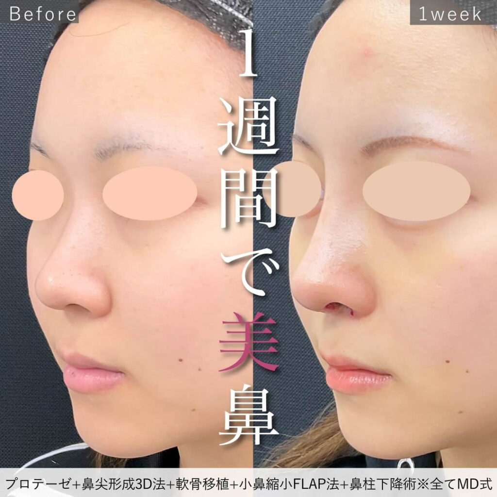 プロテーゼ＋鼻尖形成3D法＋軟骨移植＋小鼻縮小FLAP法＋鼻柱下降術の症例写真