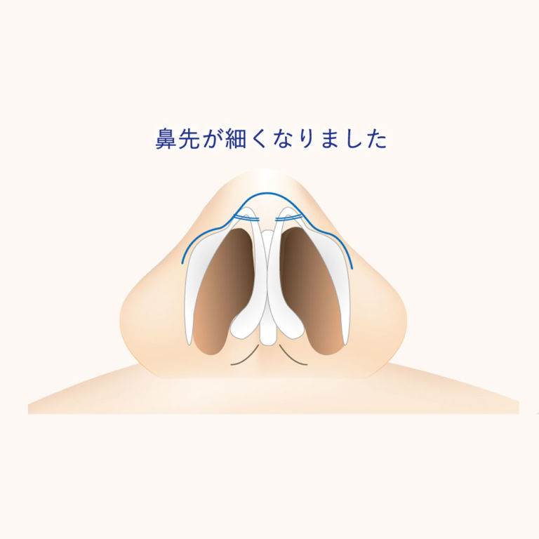鼻尖形成や3D法の料金や手術方法 |新宿と池袋の美容整形は東京シンデレラ美容外科