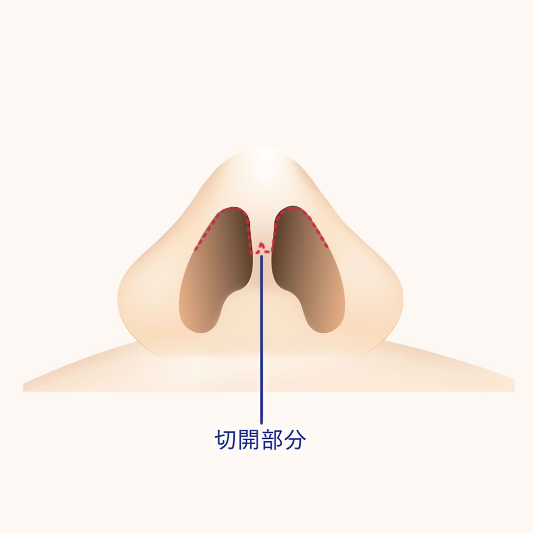 鼻尖形成オープン法の図解