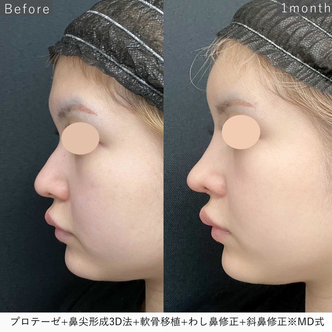 プロテーゼ＋鼻尖形成3D法＋軟骨移植＋わし鼻修正＋斜鼻修正※全てMD式