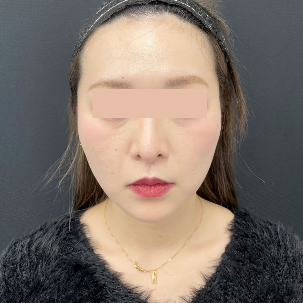 糸リフトの症例手術1ヵ月後