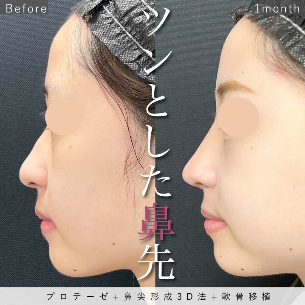 シリコンプロテーゼ＋鼻尖形成3D法＋軟骨移植の症例写真１３