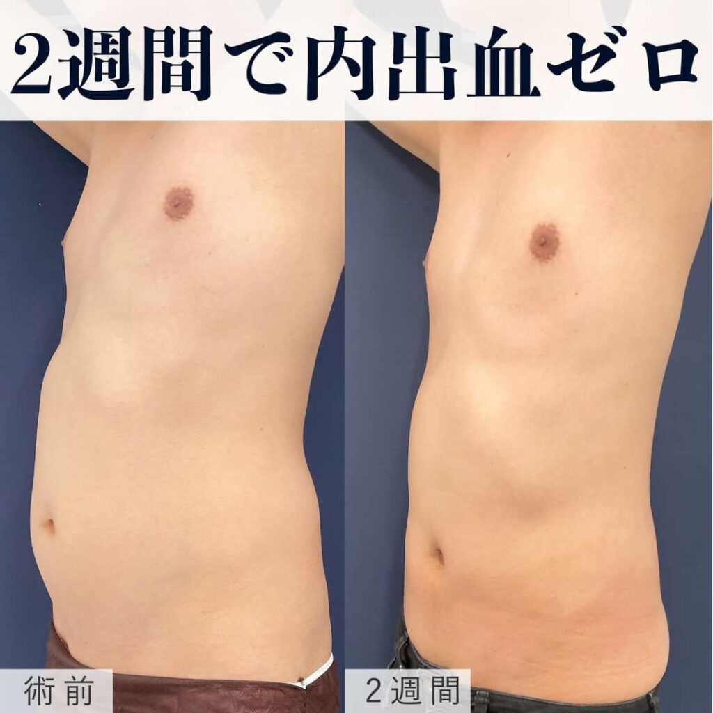 脂肪吸引を受けた男性の手術前と2週間後の症例写真