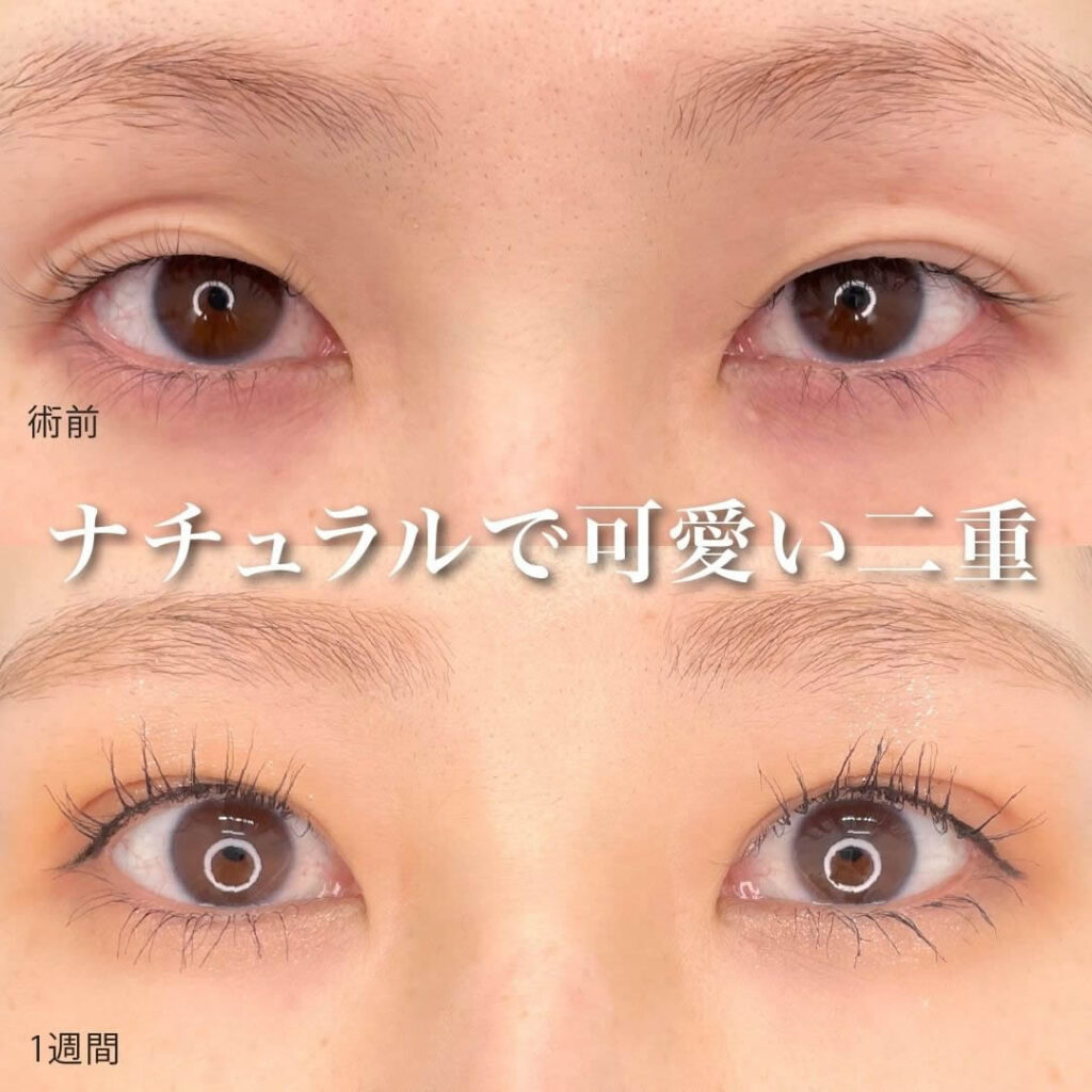 クイックシンデレラ・ダブルと眼瞼下垂（タッキング）の症例写真