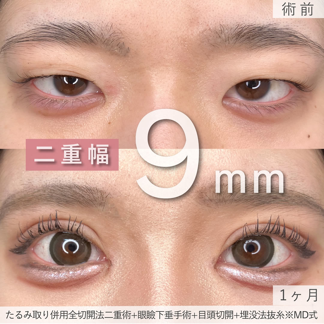 眼瞼下垂の症例