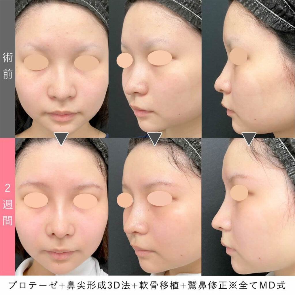 シリコンプロテーゼ＋鼻尖形成3D法＋軟骨移植＋ワシ鼻修正＋MD式のの症例写真