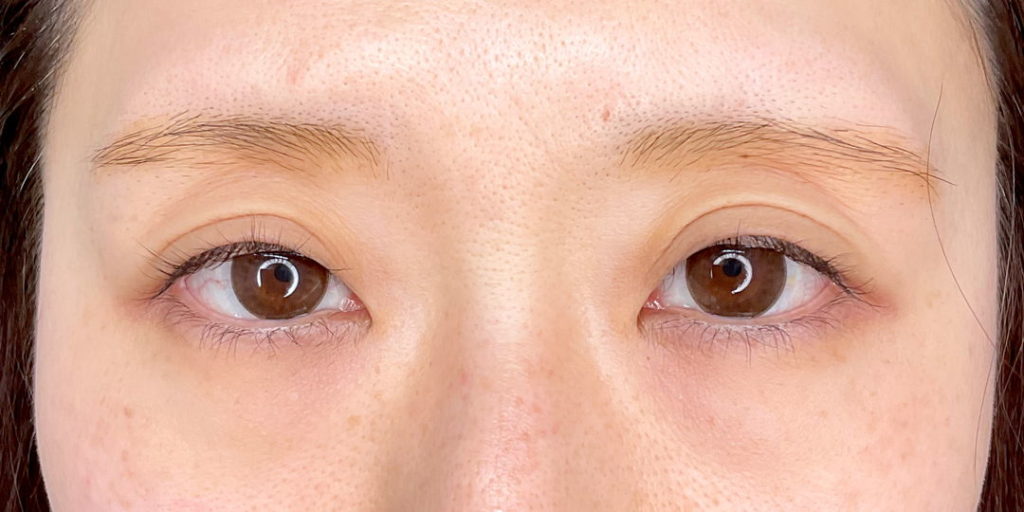 中度の眼瞼下垂の患者