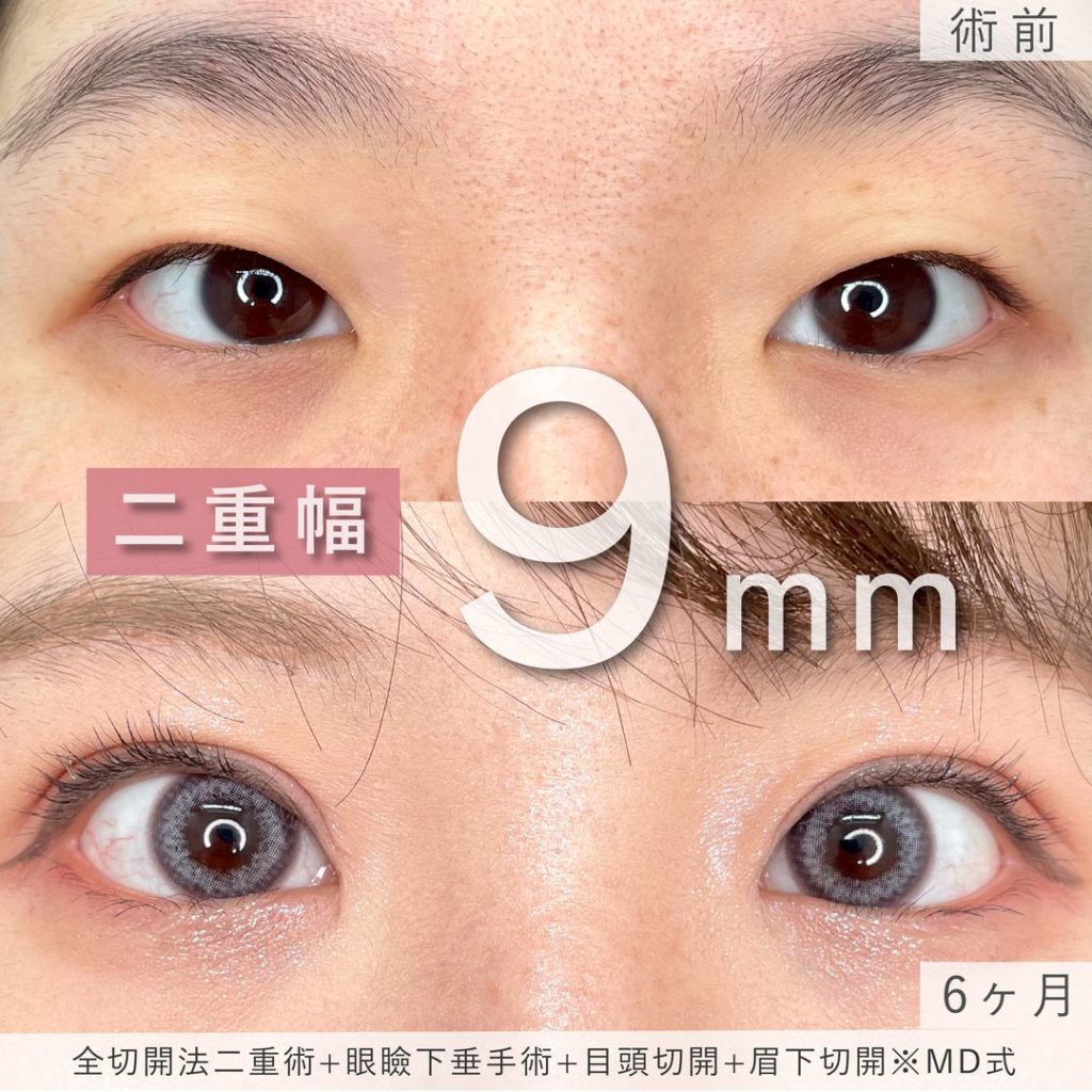 二重幅が変わった眼瞼下垂の症例写真