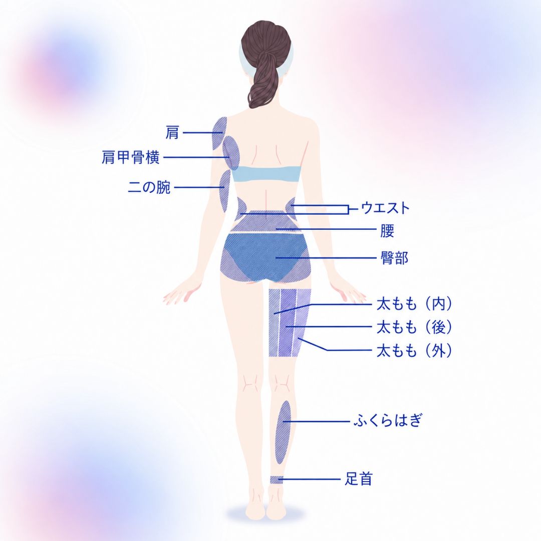 脂肪吸引の背面の吸引部位