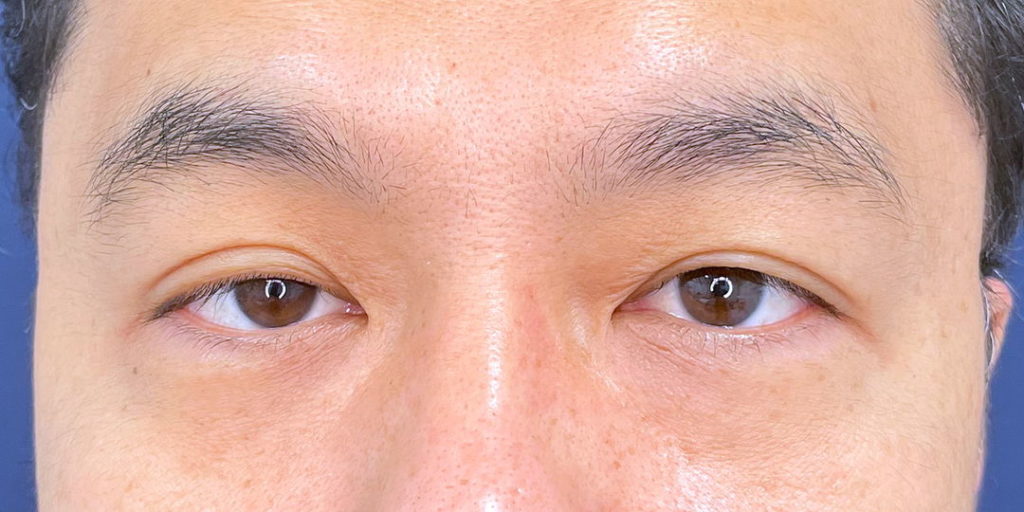 重度の眼瞼下垂の患者