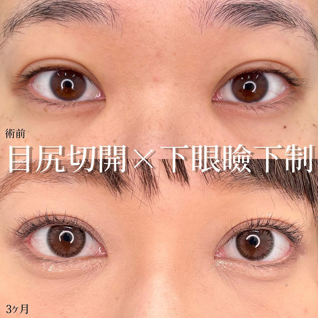 目尻切開と下眼瞼下制（結膜切開）の症例写真