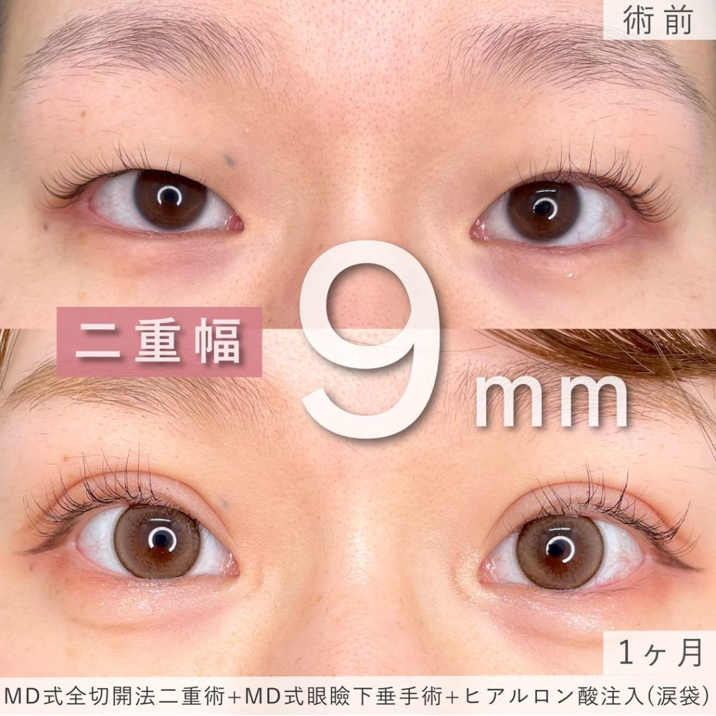 二重幅が９ミリになった眼瞼下垂の１か月後の症例
