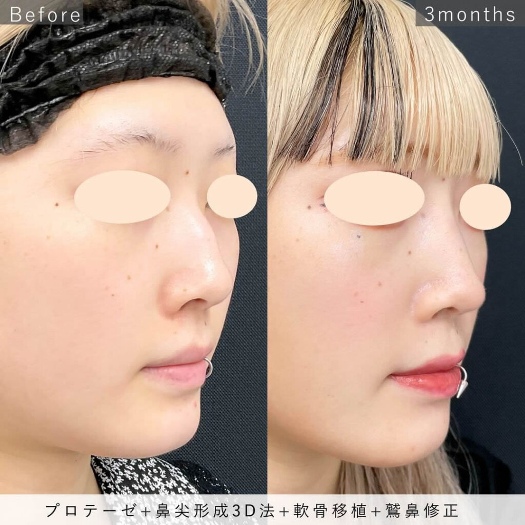 シリコンプロテーゼ＋鼻尖形成3D法＋軟骨移植＋ワシ鼻修正の症例写真８
