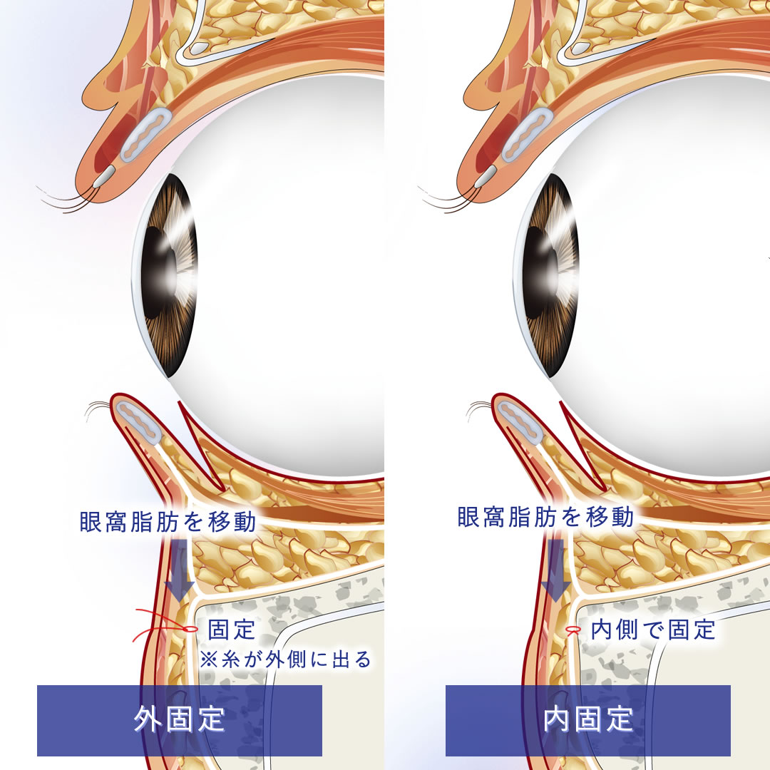目の断面図で解説する裏ハムラの眼窩脂肪を移動再配置した図解
