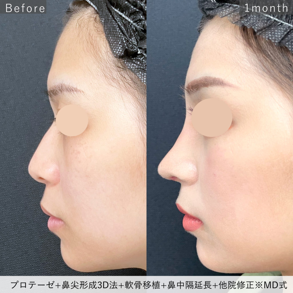 011_MD式プロテーゼ＋鼻尖3D＋軟骨移植＋鼻中隔延長耳介軟骨＋修正中度