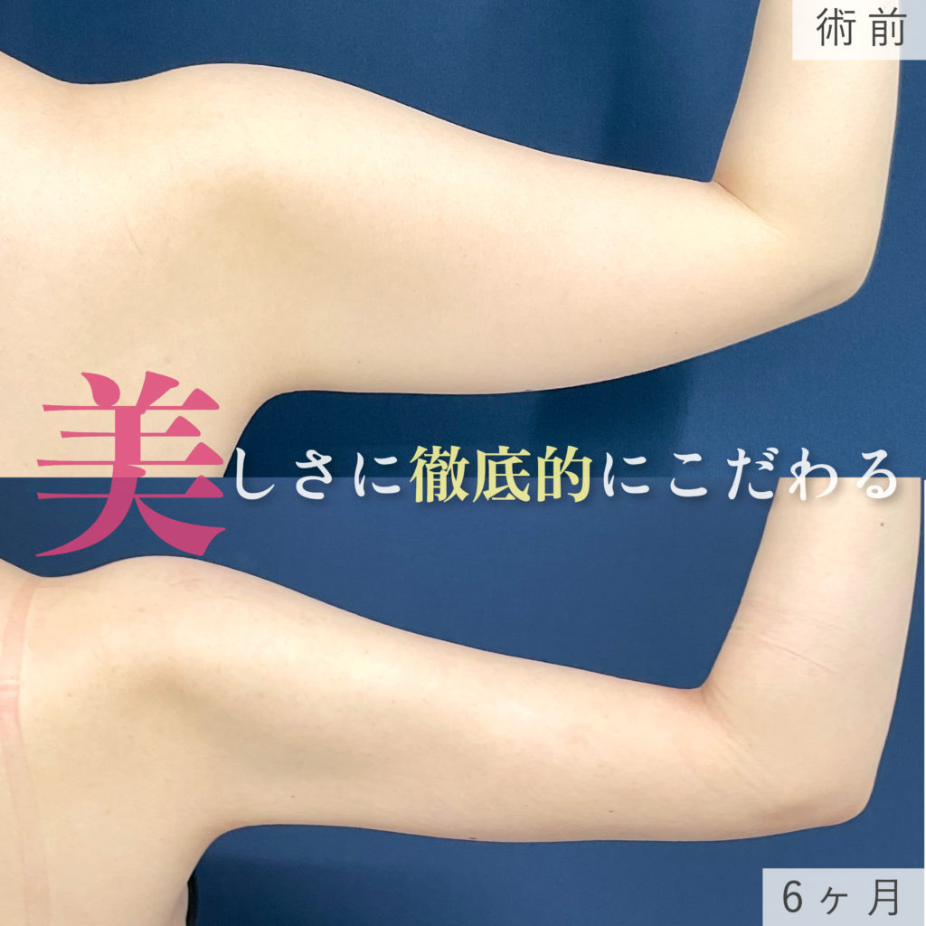 二の腕と肩のシンデレラ脂肪吸引の症例写真