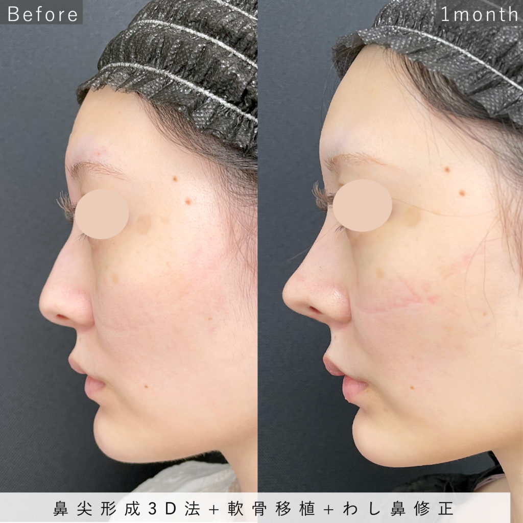 鼻尖形成3D法と軟骨移植とわし鼻修正の術前と1か月後の横向きの症例写真