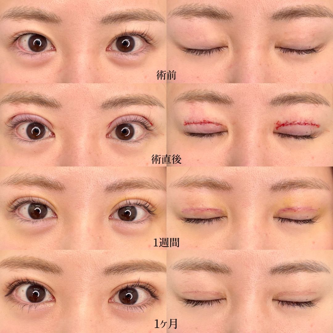 切開法ダウンタイムの症例写真