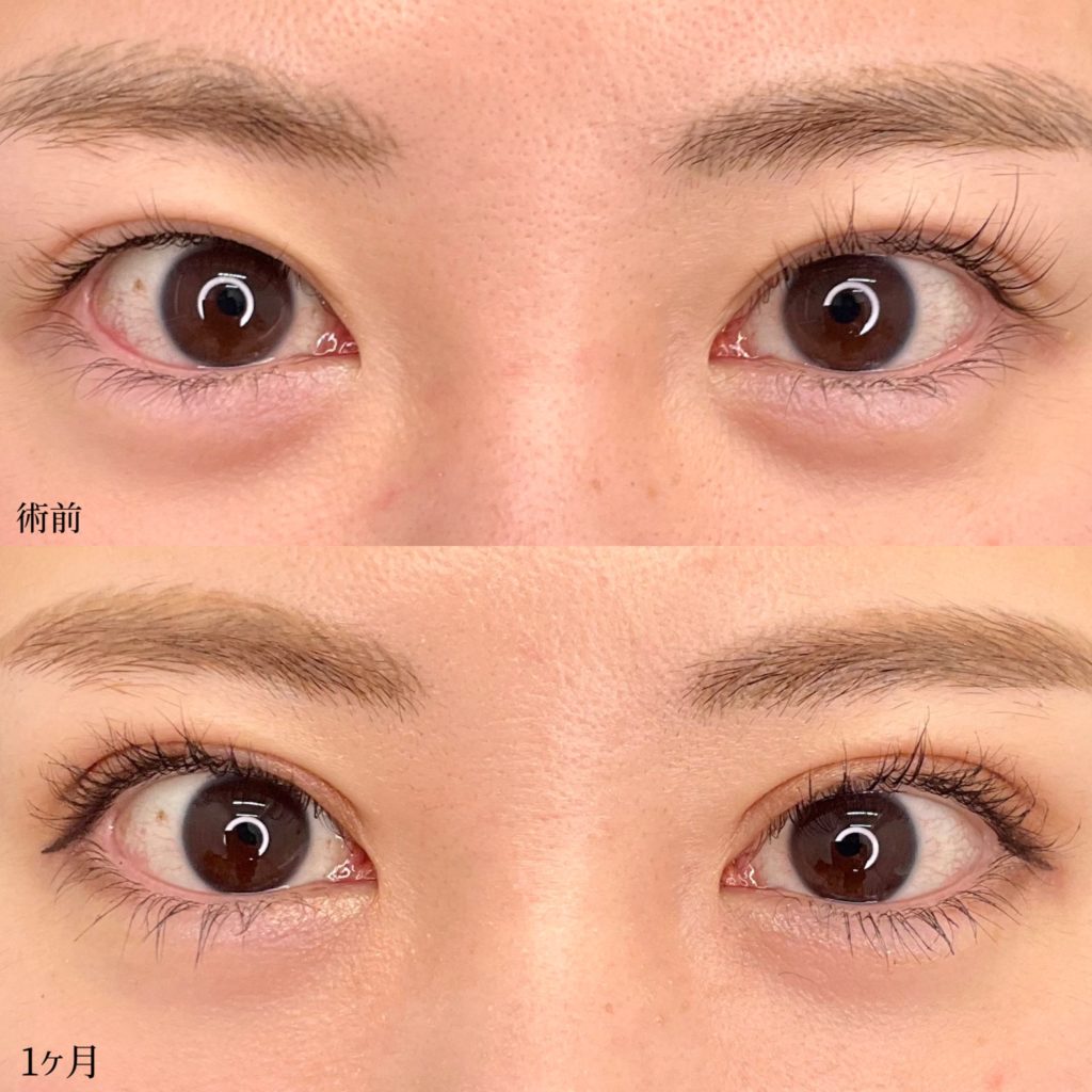 切開法の術前と1か月後の症例写真