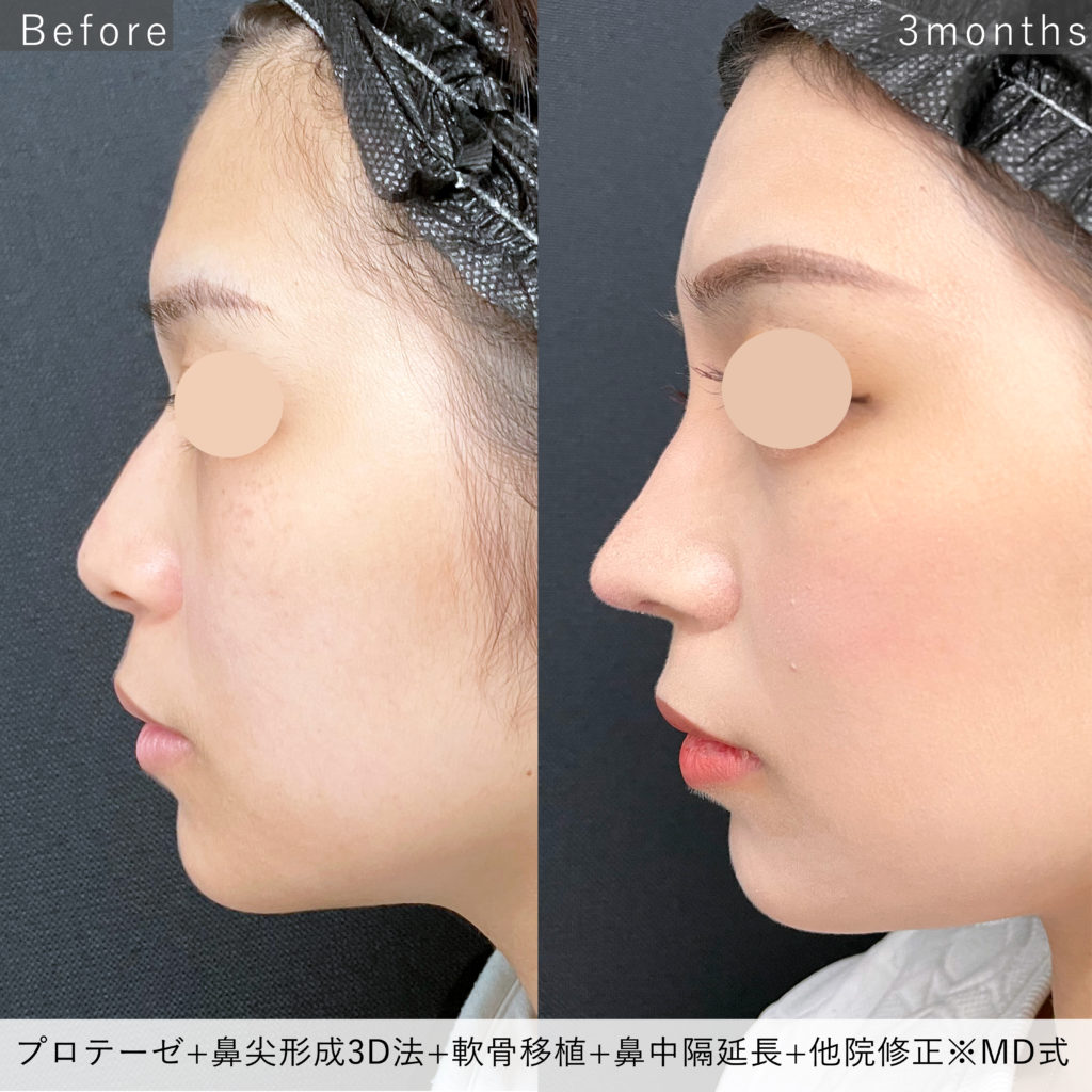 鼻のプロテーゼと鼻尖形成3D法と軟骨移植と鼻中隔延長耳介軟骨と他院修正の手術前と3か月後の症例写真