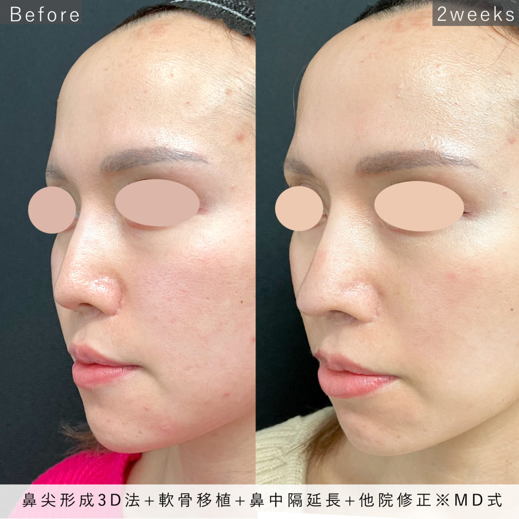 019_MD式鼻尖形成3D+軟骨移植+鼻中隔延長+他院修正