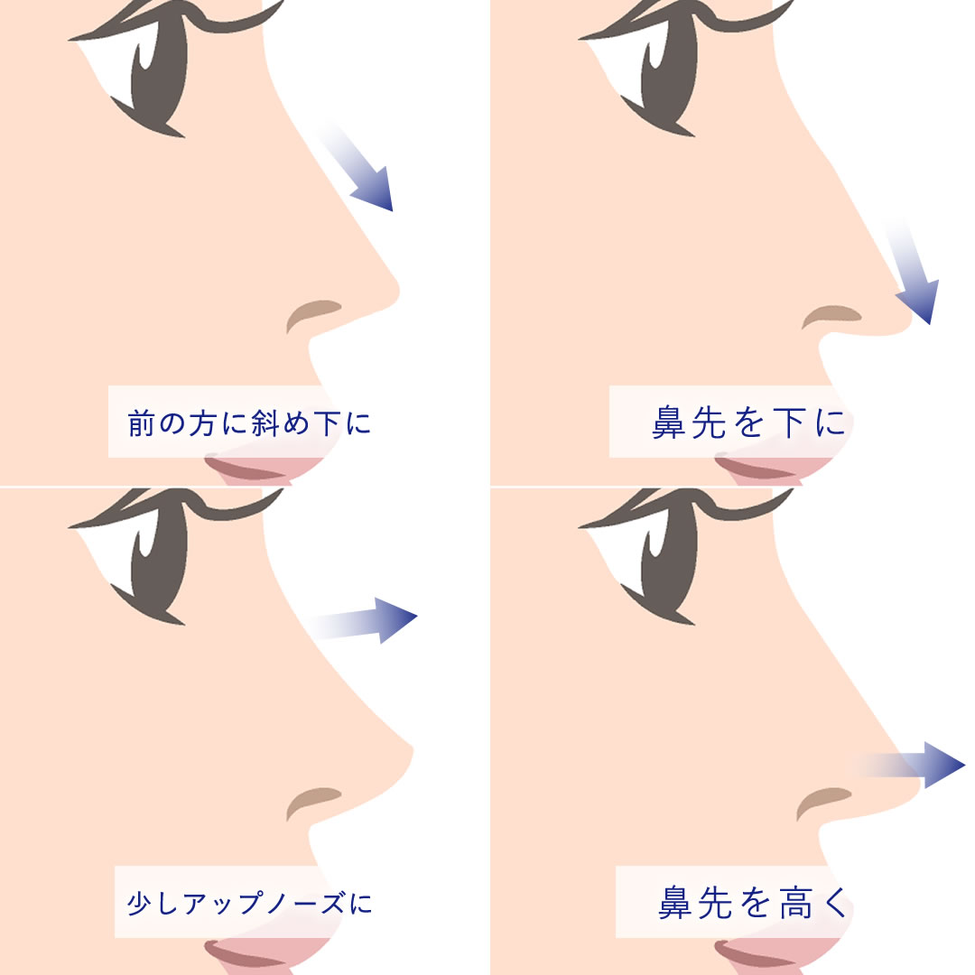 鼻中隔延長手術でできる鼻の方向