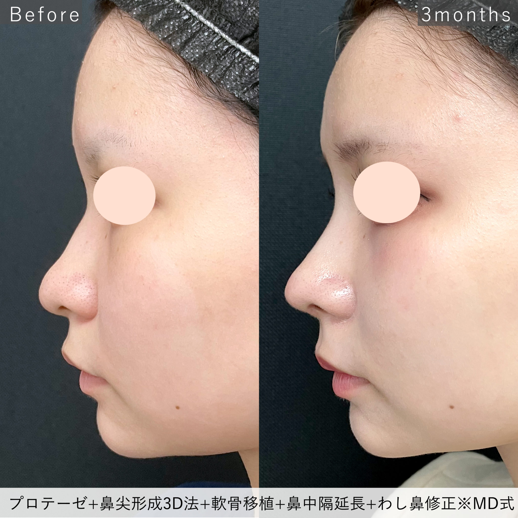 鼻尖形成と鼻中隔延長の違いを医師が解説|美容整形は東京シンデレラ美容外科 鼻尖形成と鼻中隔延長の違いを医師が解説|美容整形は東京シンデレラ美容外科