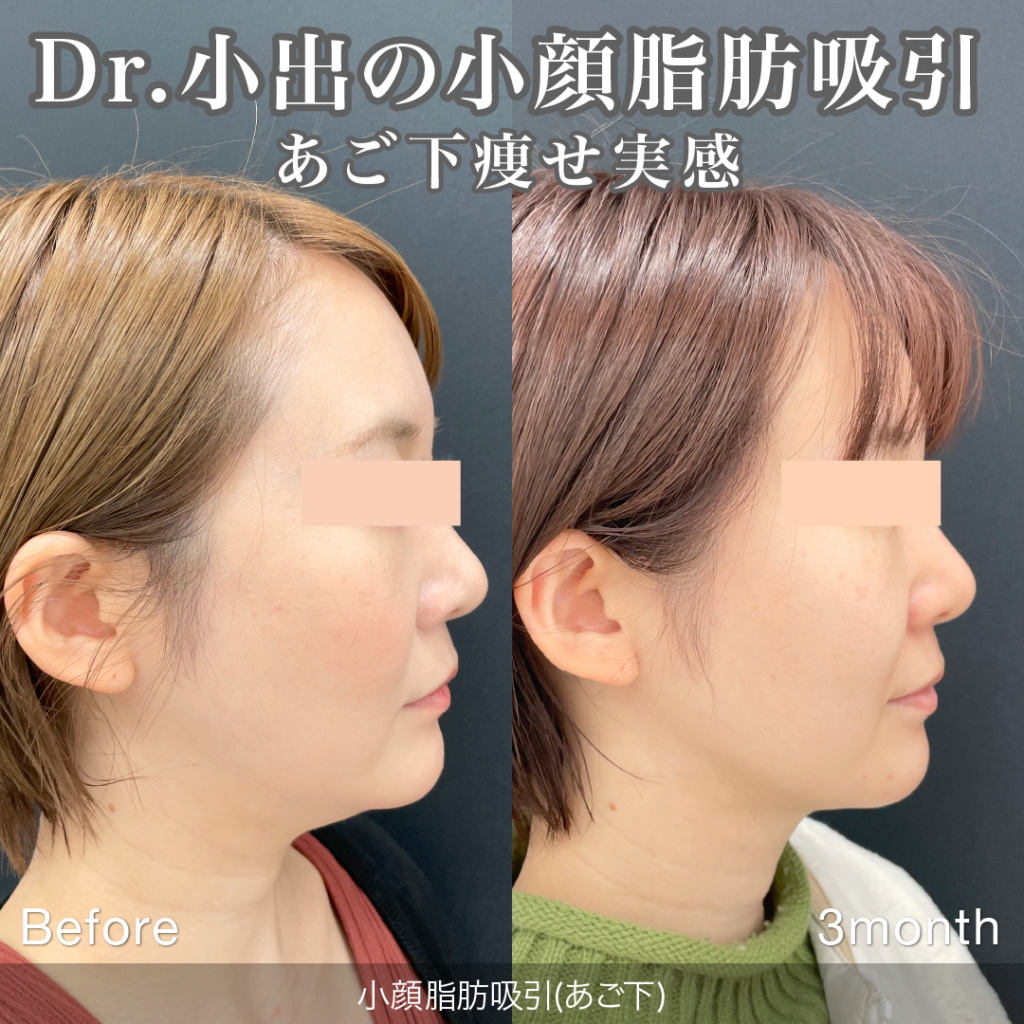 小顔脂肪吸引の手術前と3か月後の経過の症例写真