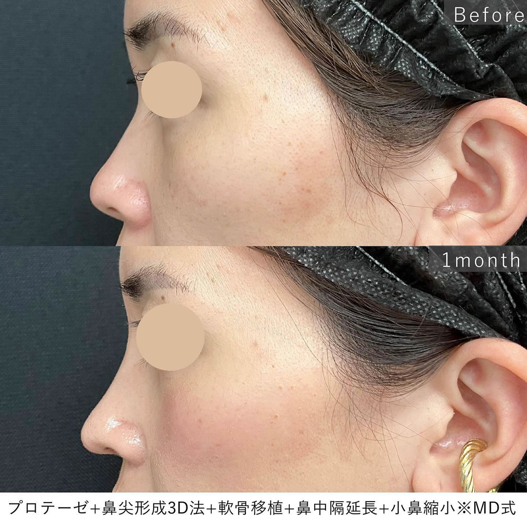 鼻のプロテーゼと鼻尖形成3D法と軟骨移植と小鼻縮小内側法と鼻中隔延長をMD式で行った女性の症例