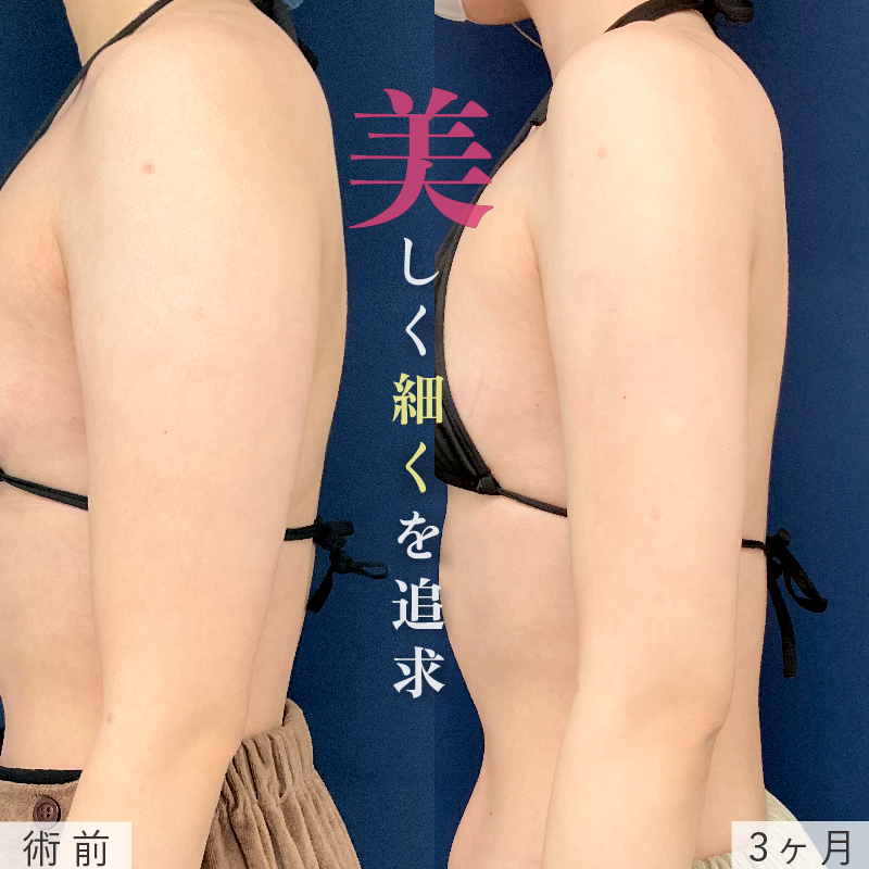 アキーセル脂肪吸引(二の腕・肩)の術前と3か月後の症例写真