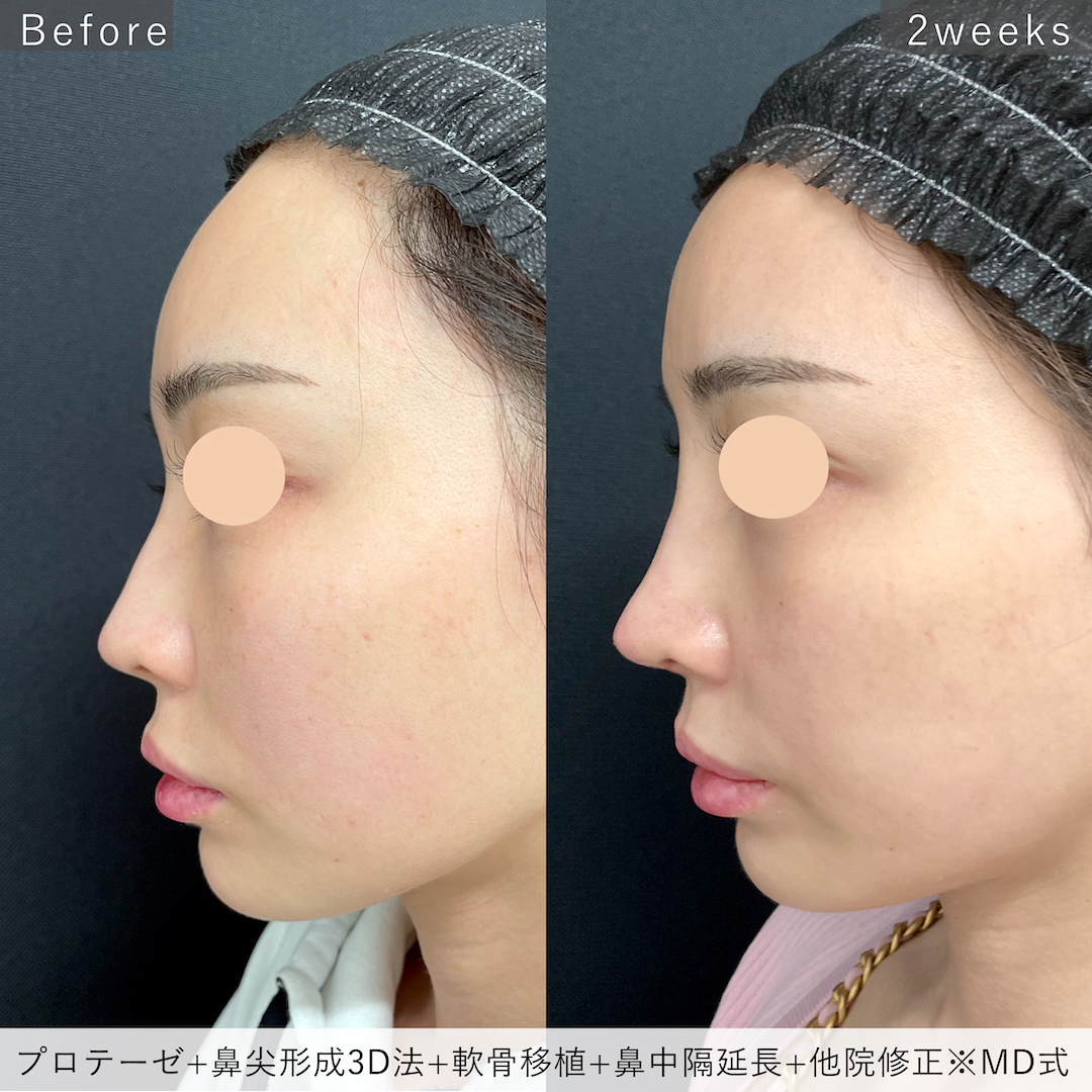プロテーゼと鼻尖形成3D法と軟骨移植と鼻中隔延長と他院修正の症例写真