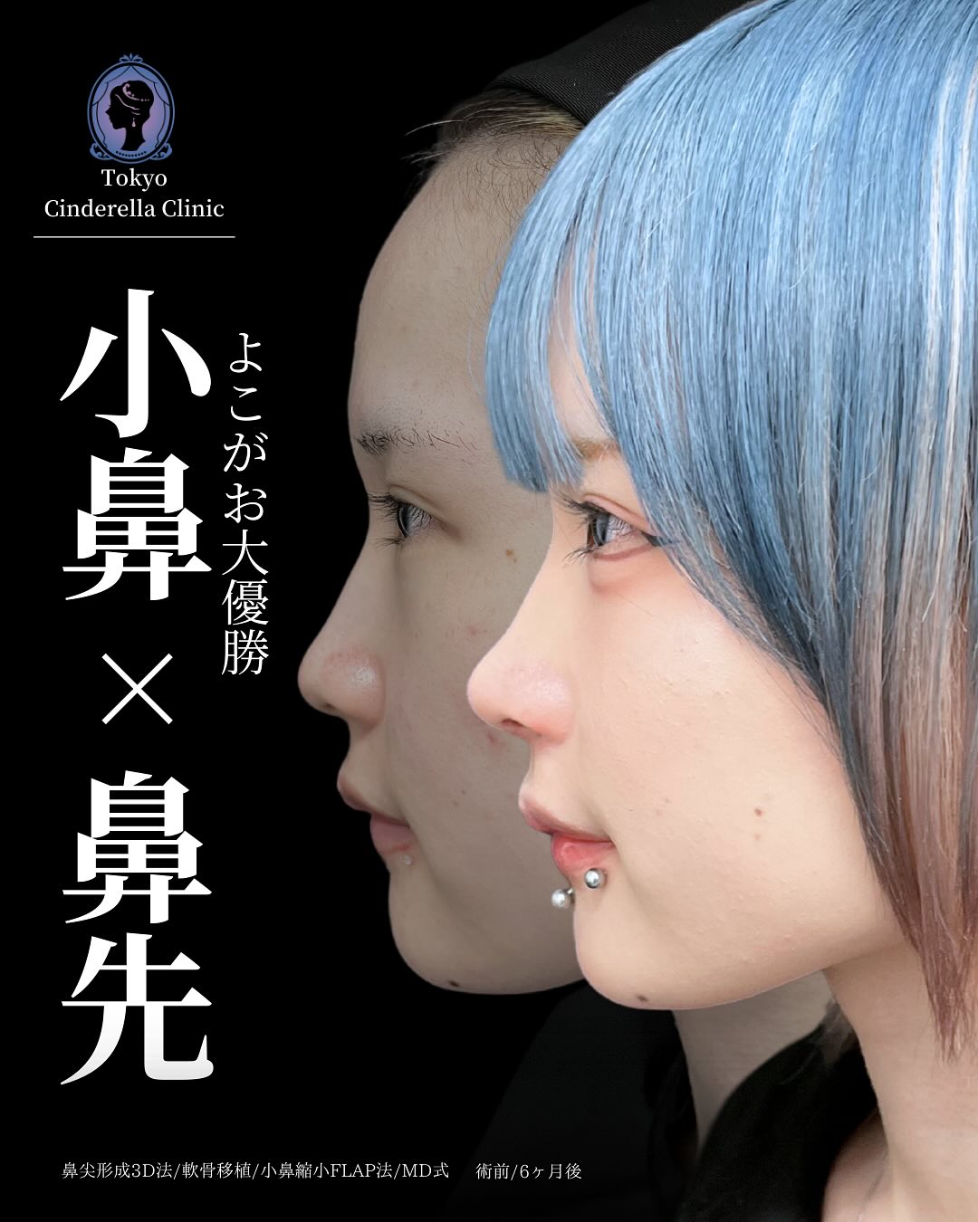 【鼻】鼻尖形成 3D法 軟骨移植 小鼻縮小FLAP法 MD式