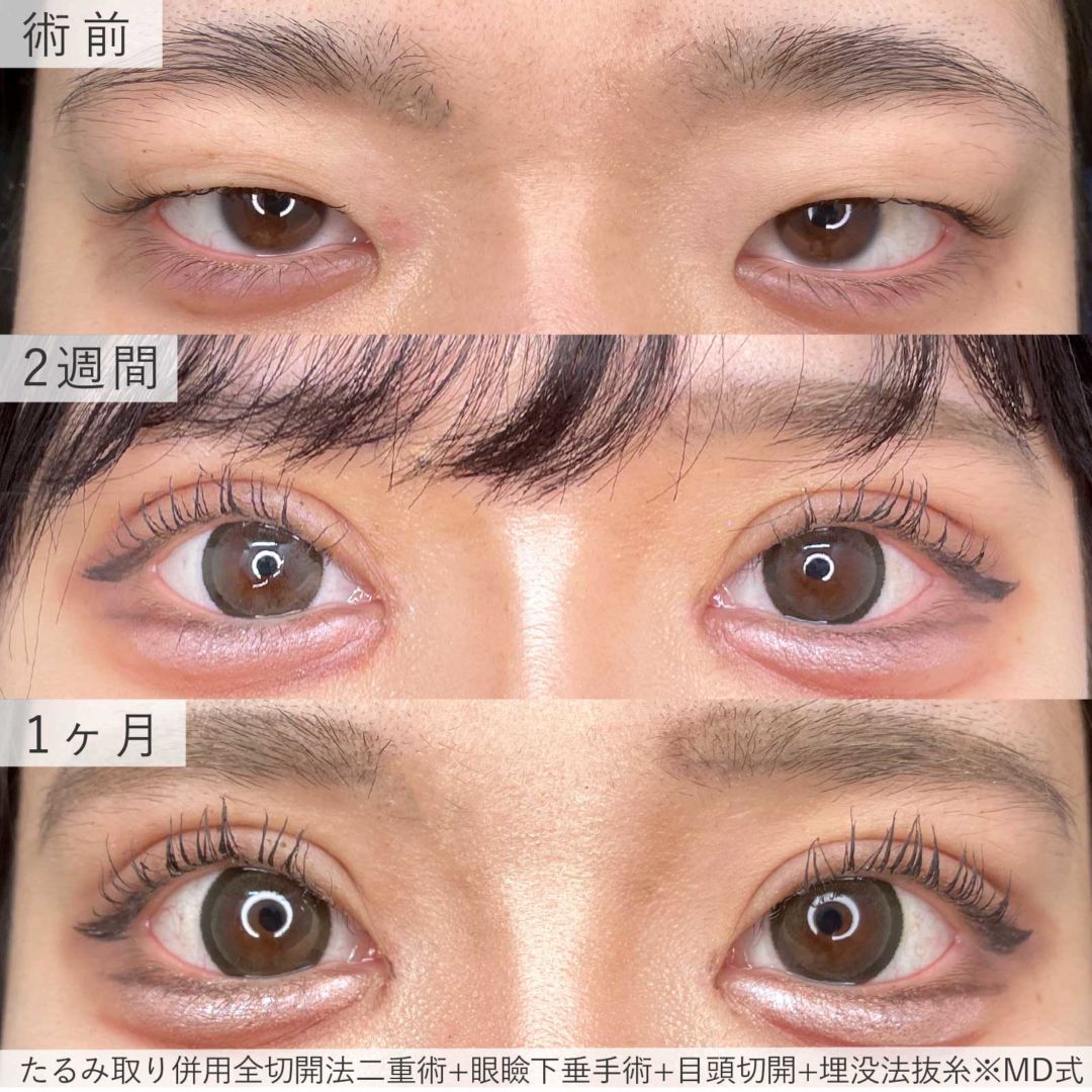 MD式たるみ取り併用全切開法二重術と眼瞼下垂手術と目頭切開と埋没法抜糸の症例写真