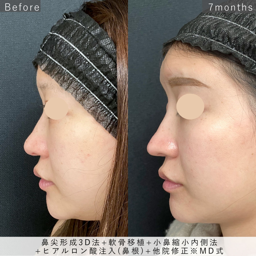 MD式鼻尖形成3Dと軟骨移植と小鼻縮小内側法とヒアルロン酸注入と他院修正の症例写真
