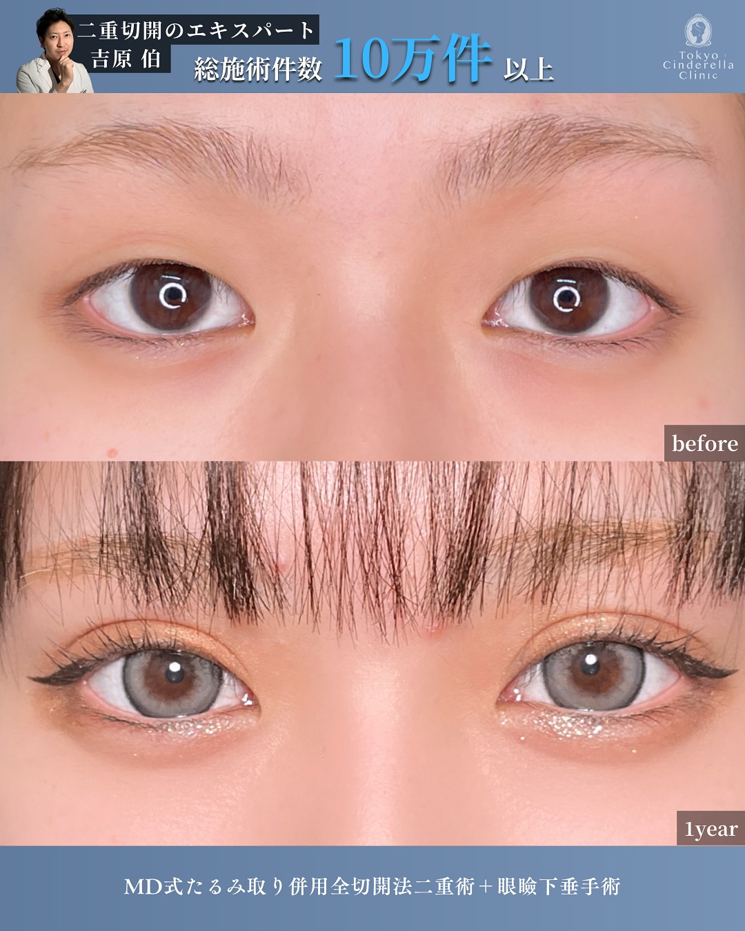 【目】たるみ取り併用全切開法二重術 ・眼瞼下垂手術 ・MD式