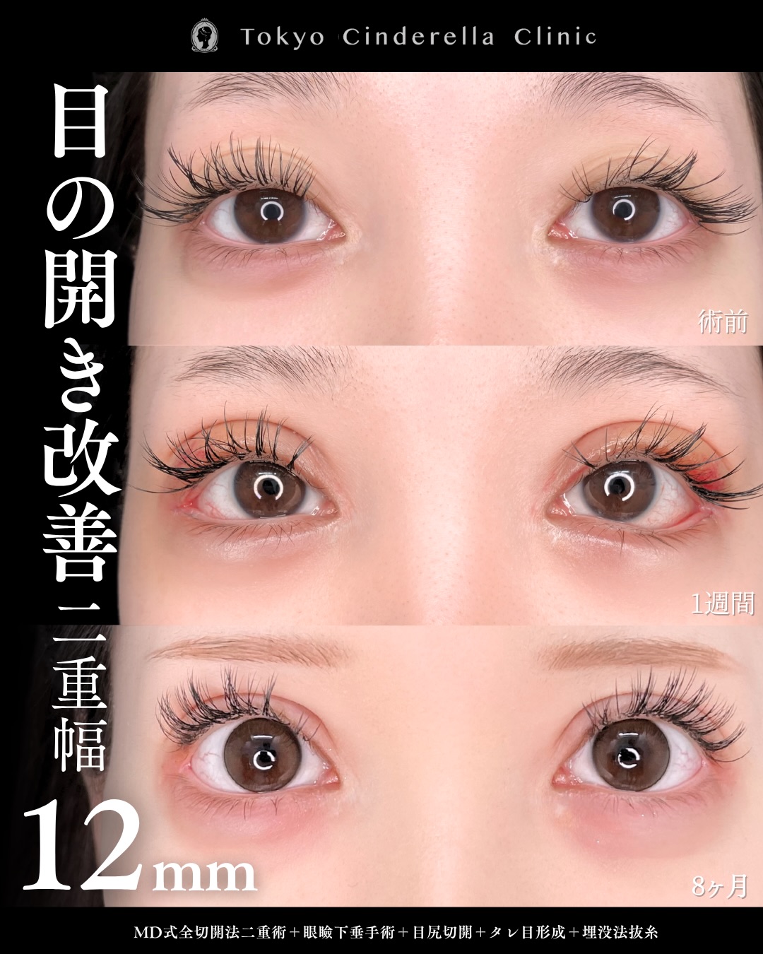 【目】・全切開法二重術 ・眼瞼下垂手術 ・目尻切開 ・タレ目形成(結膜切開) ・埋没法抜糸 ・MD式