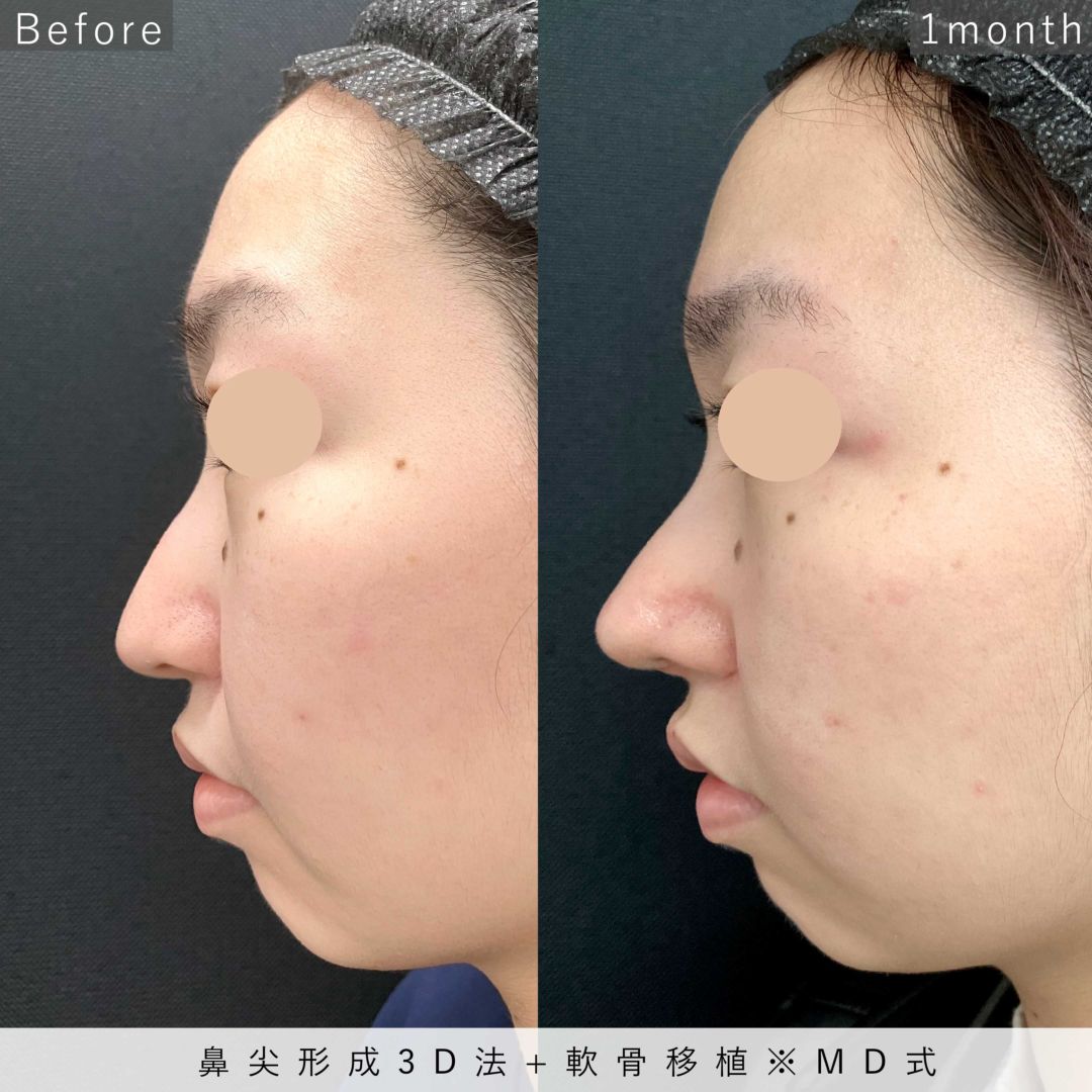 鼻尖形成をした女性の1ヶ月後の症例写真