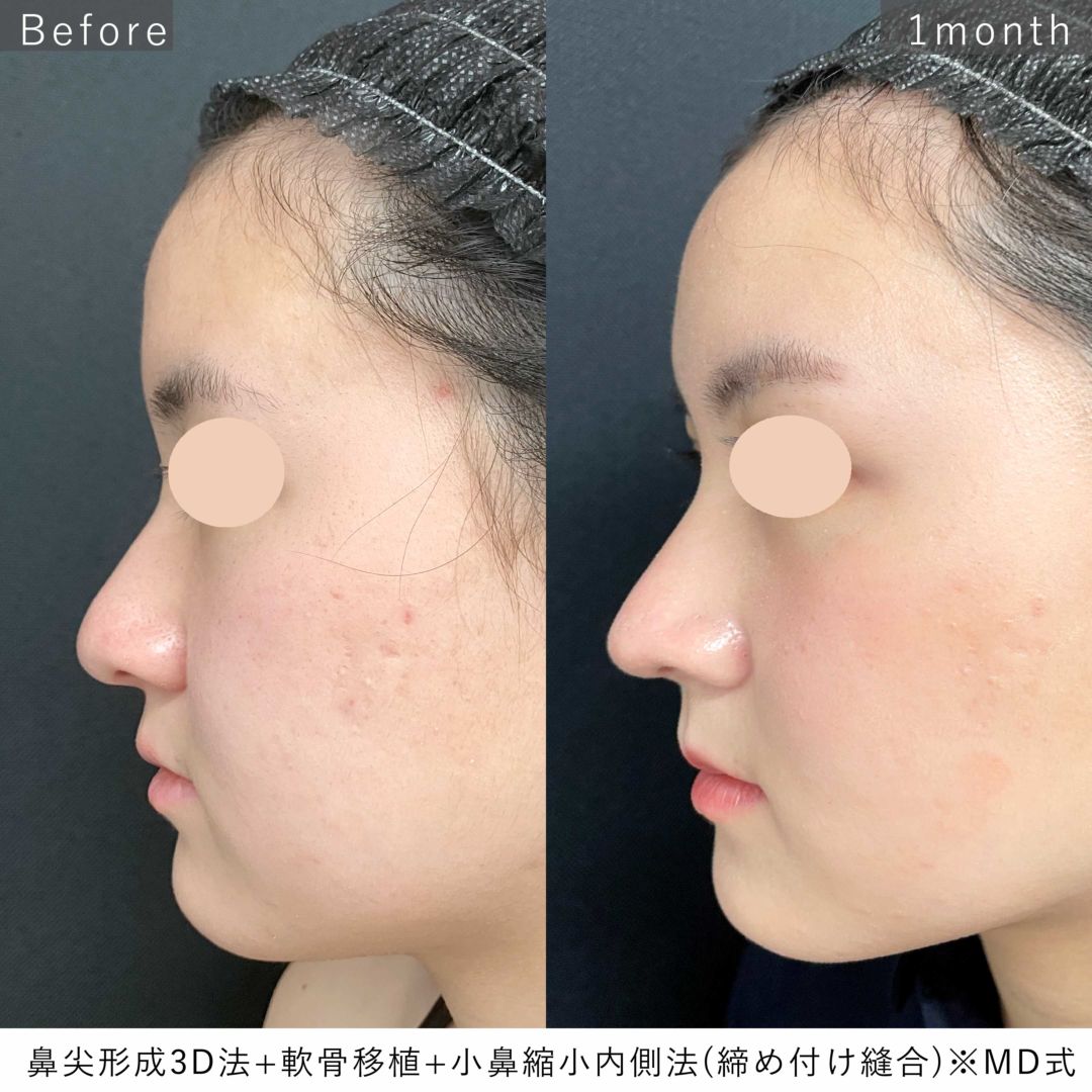 MD式鼻尖形成3Dと軟骨移植と小鼻縮小内側法(締め付け縫合)の症例写真