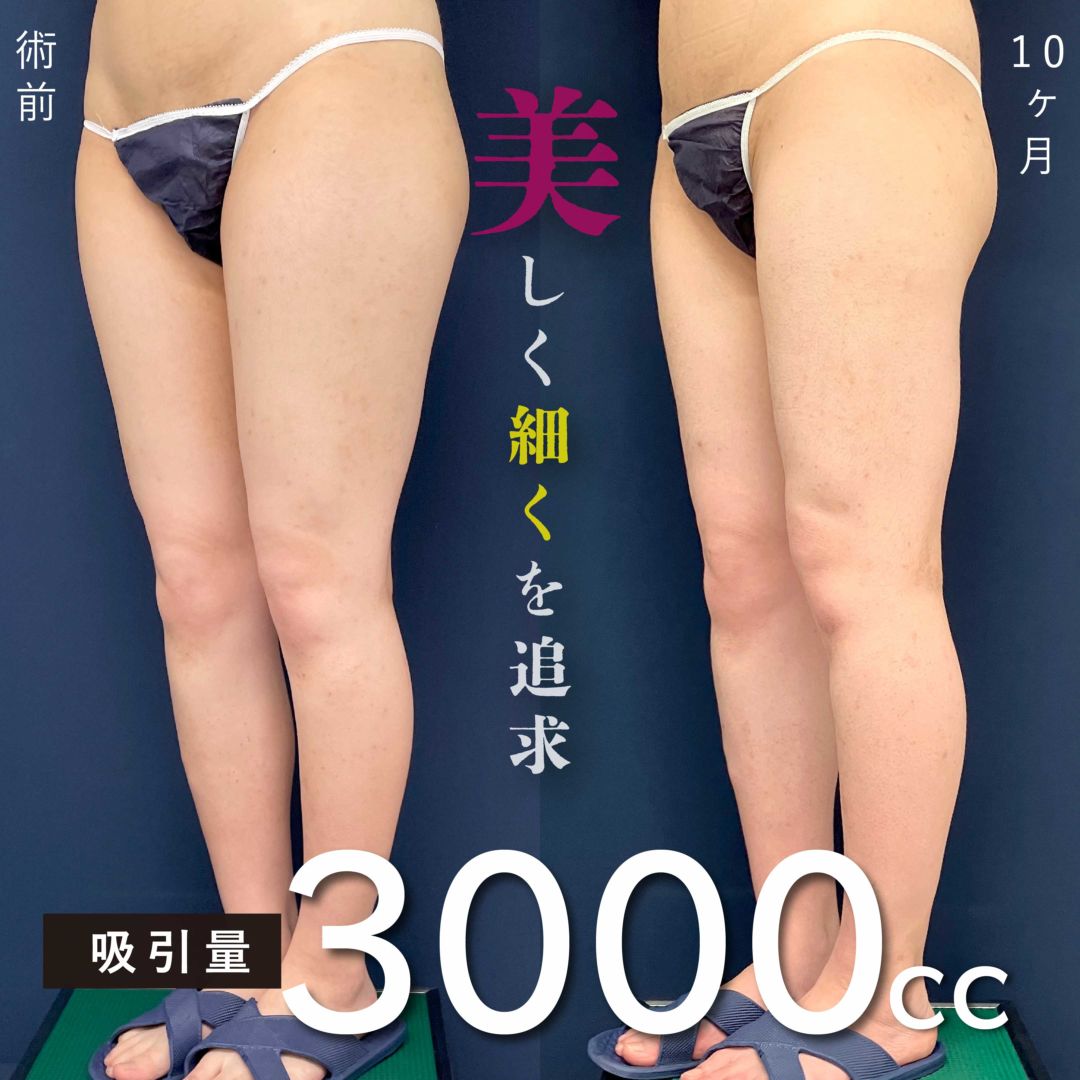 脂肪吸引(大臀膝)の正面から見た症例写真