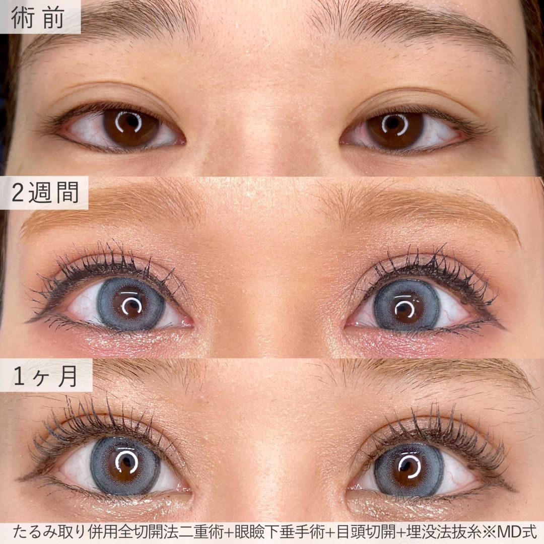 全切開・眼瞼下垂手術・目頭切開のダウンタイムの症例写真