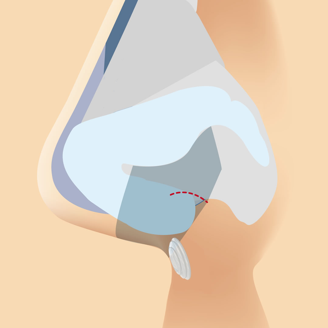 耳軟骨が鼻柱基部に固定されている図解