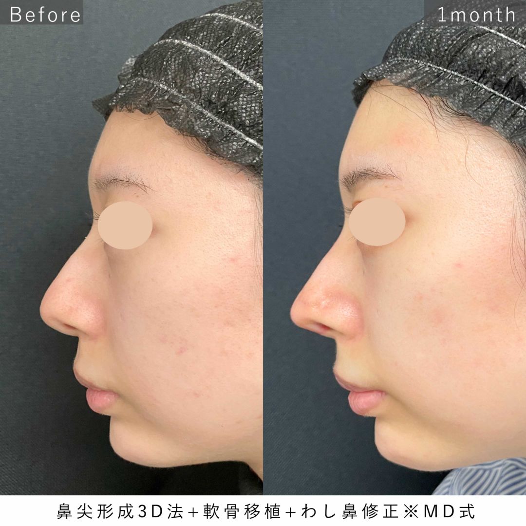 鼻尖形成と軟骨移植とわし鼻修正の手術前と1ヶ月後の症例写真