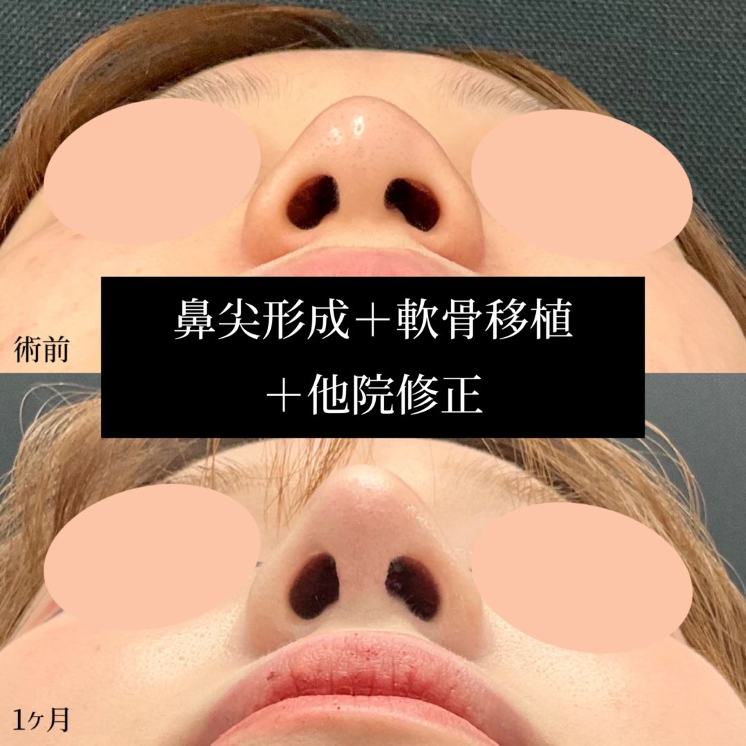 20代の鼻尖形成の症例