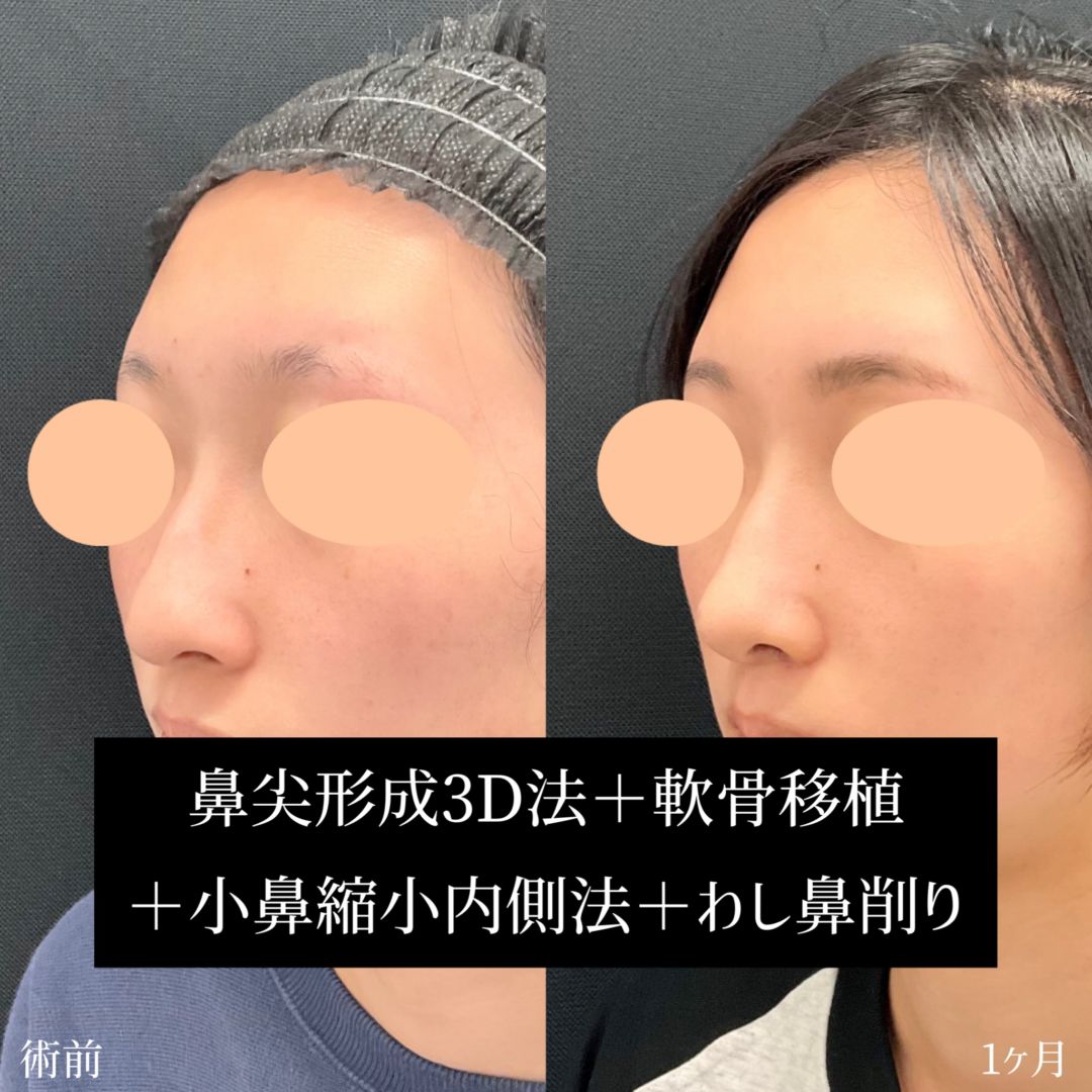 軟j骨移植のダウンタイムの経過の症例写真