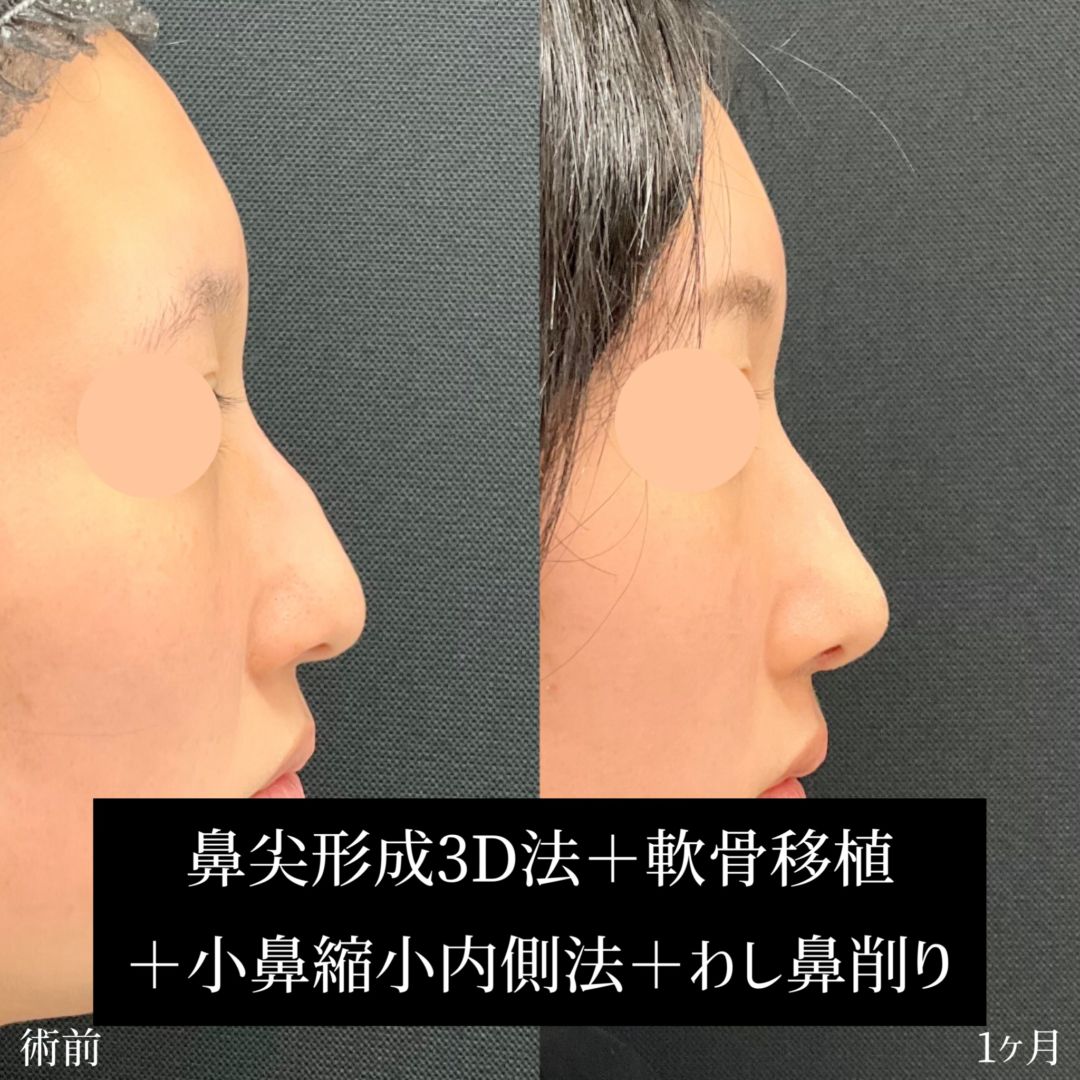 鼻尖形成のダウンタイムの経過の症例写真