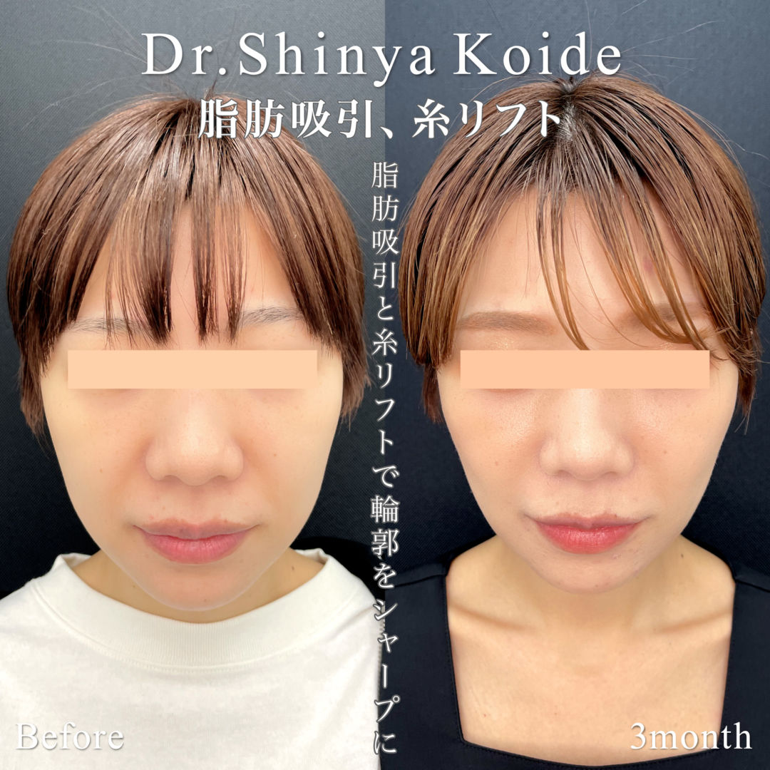 小顔脂肪吸引と糸リフトの手術前と3か月後の症例写真