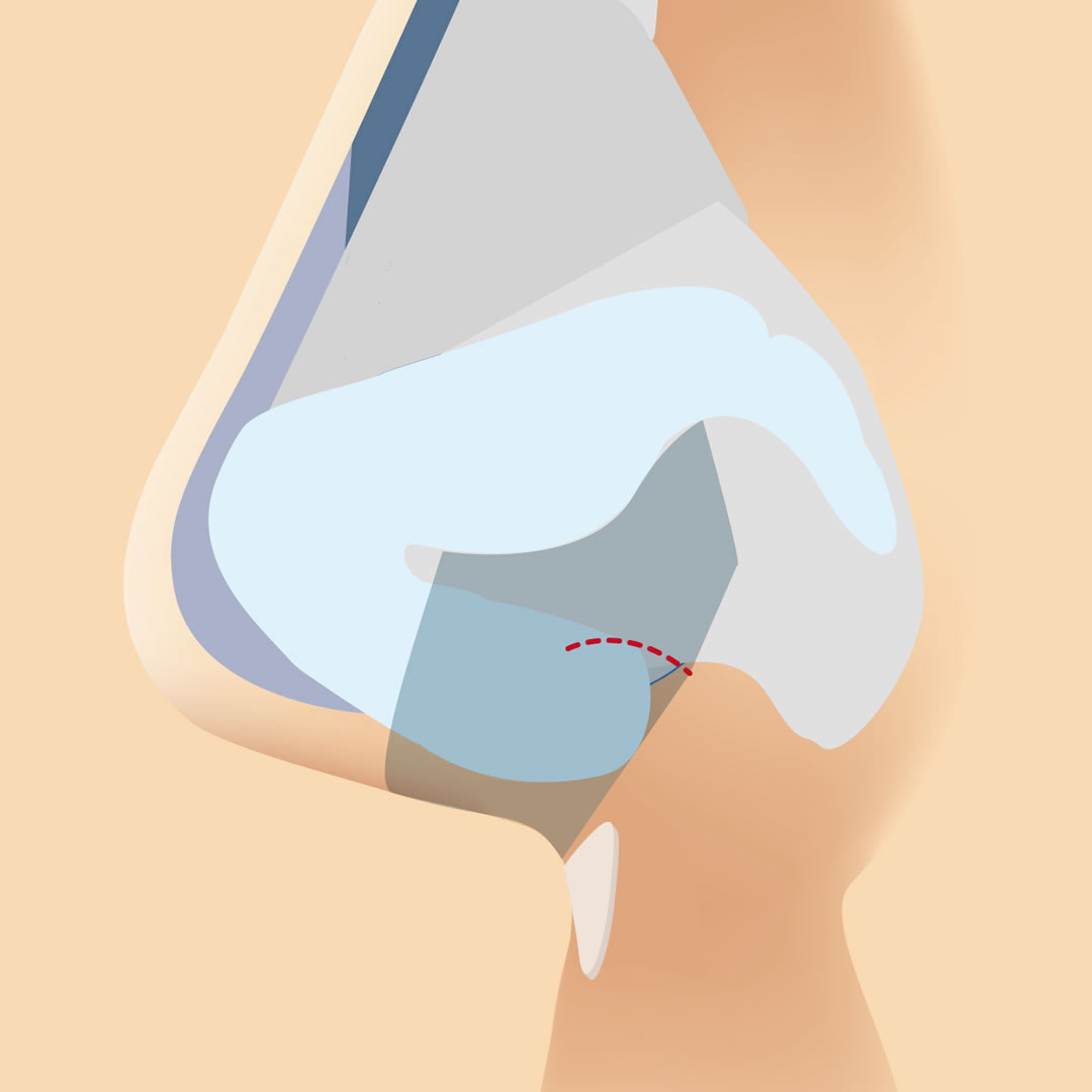 プロテーゼが鼻柱基部に固定されている図解